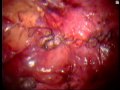 Urological surgeons have become proficient at performing complex pelvic urological procedures, such as radical prostatectomy, using the laparoscopic approach. Declan Murphy and Daniel Moon share their experience of four less common procedures they have performed recently using laparoscopic techniques. These include: excision of a urachal cyst; partial cystectomy for endometriosis (combined endoscopic-laparoscopic approach); repair of an intra-peritoneal bladder rupture; and repair of a ureteric injury (combined endoscopic-laparoscopic approach). This video was shown at the Urological Society of Australia and New Zealand meeting in Hong Kong, February 2008.