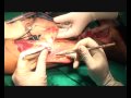 An defect on the posterior ankle exposing the tendoachilles and a fractured calcaneum covered with a sural artery flap. The flap was distally based, islanded and covered the area with vascularised tissue well. The defect, plot, execution and final result shown.