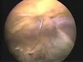 Two port laparoscopic hernia repair Laparoscopic Hernia Repair