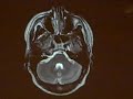 Normal Transverse MRI 1