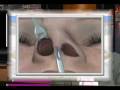 ρινοπλαστική 3-D animation, Live surgery! 4.  Ν. Καποσίτας M.D,PhD,
