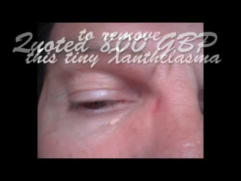 how to cure xanthelasma naturally