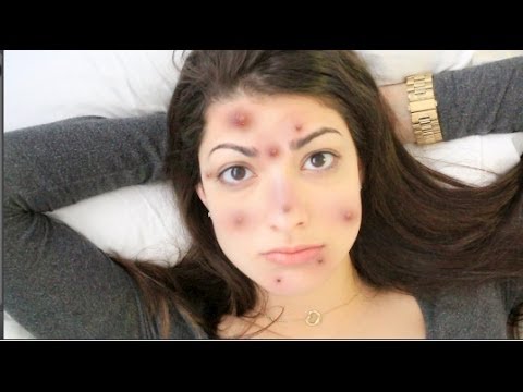 How to Get Rid of Acne Overnight! (Guaranteed less acne)