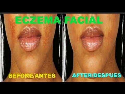 how to know if eczema is healing