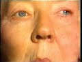 Downbeat Nystagmus Downbeat Nystagmus
