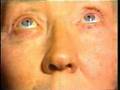 Downbeat Nystagmus