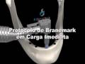PROTOCOLO DE BRANEMARK, CARGA IMEDIATA, SIMULAÇÃO VIRTUAL. CLÍNICA FDANTAS, ESPECIALIZADA EM REABILITAÇÃO E IMPLANTES ORAIS. WWW.FDANTAS.COM.BR