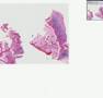 Histopathology Bone, vertebra--Adenocarcinoma, metastatic