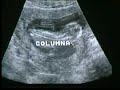 Ultrasonido de mi hijo a los 3 meses de embarazo Ultrasonido de mi hijo a los 3 meses de embarazo