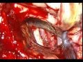 SKULL BASE meningioma-planum sphenoidal-dr suresh dugani/hubli/india