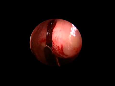 how to drain ethmoid sinuses
