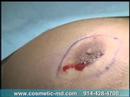 how to perform gynecomastia surgery