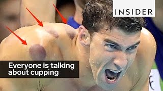 Cupping 拔罐