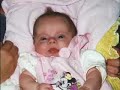 Hope for a Brighter Future Osteogenesis Imperfecta