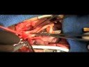 HLHS - Pediatric Heart Surgery HLHS - Pediatric Heart Surgery