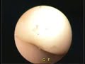 Neurocirurgia endoscopica