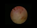 Dr. March - Hysteroscopy: Lysis of Adhesions Adhesions