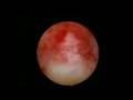 Dr. March - Hysteroscopy: Lysis of Adhesions