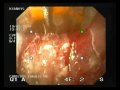 Barrett's Esophagus - Halo 90 Endoscopic Therapy Barrett's Esophagus - Halo 90 Endoscopic Therapy