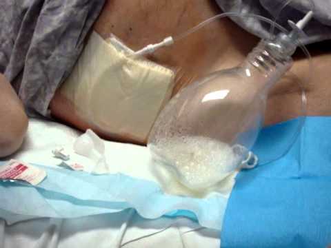how to drain aspira chest tube