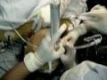 intubacion secuencia rapida hospital naval