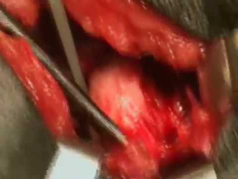 Cirurgia de Displasia Coxofemural