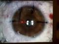 Joe's LASIK