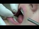 Recementing a Molar Band