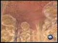 Cellulite Endemologie LipoMassage At Metamorphosis Day Spa