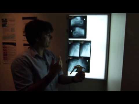 how to cure osteophytes