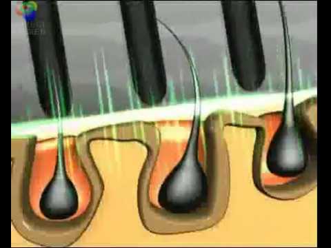 how to treat alopecia x