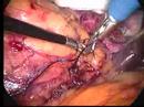 Surgeon tying knots during surgery