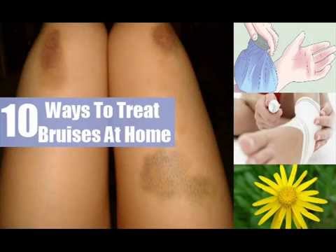 how to treat bruises