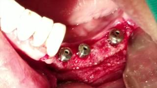 Ridge Augmentation using ASAP Protocol