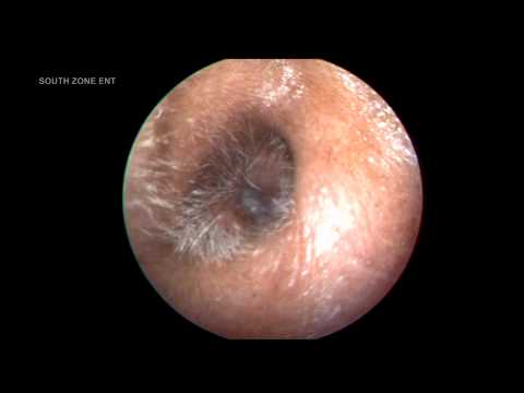 how to relieve otitis externa