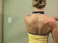 Damaged Long Thoracic Nerve - Winging Scapula