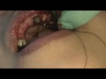 Crown Lengthening Part 6