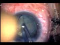 Hpermature Cataract with Nystagmus Single eye with RD in oth Hpermature Cataract with Nystagmus Single eye with RD in oth