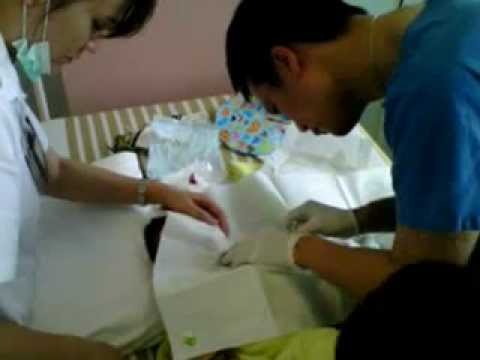 how to remove central line