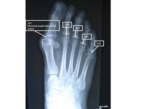 how to relieve big toe joint pain