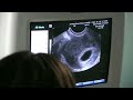 Renee and Ben's Sonogram: Baby's Heartbeat 7 weeks 2 days