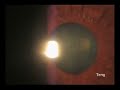 Vascular Tufts of Cobb causing Hyphema Part 1