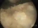 TURP