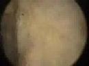 TURP
