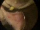 TURP