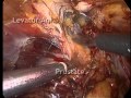Laparoscopic Radical Prostatectomy - Accessory Pudental Arteries Protection