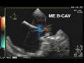 videos de TEE Sinus venosus ASD