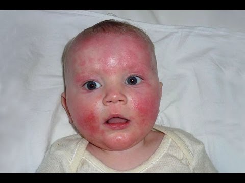 how to get rid of baby eczema