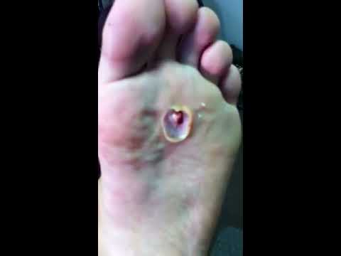 how to treat verruca