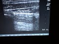 Ultrasound: Pneumothorax Ultrasound: Pneumothorax